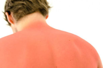 Summer Sunburn